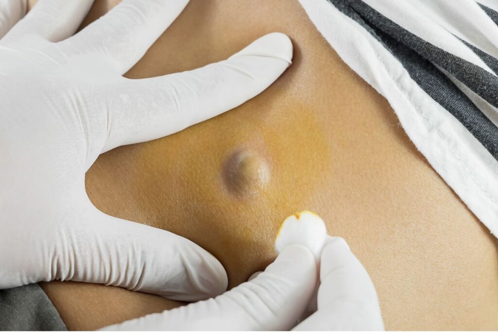 How Are Sebaceous Cysts Removed