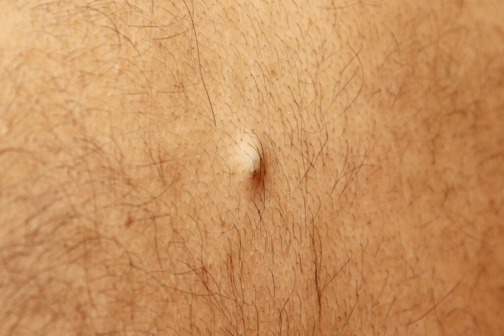 What Is a Sebaceous Cyst Made Up Of