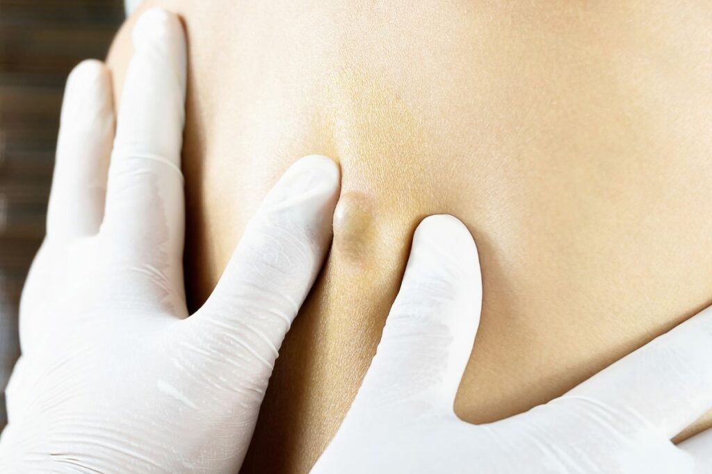 When Should You Consider Sebaceous Cyst Removal